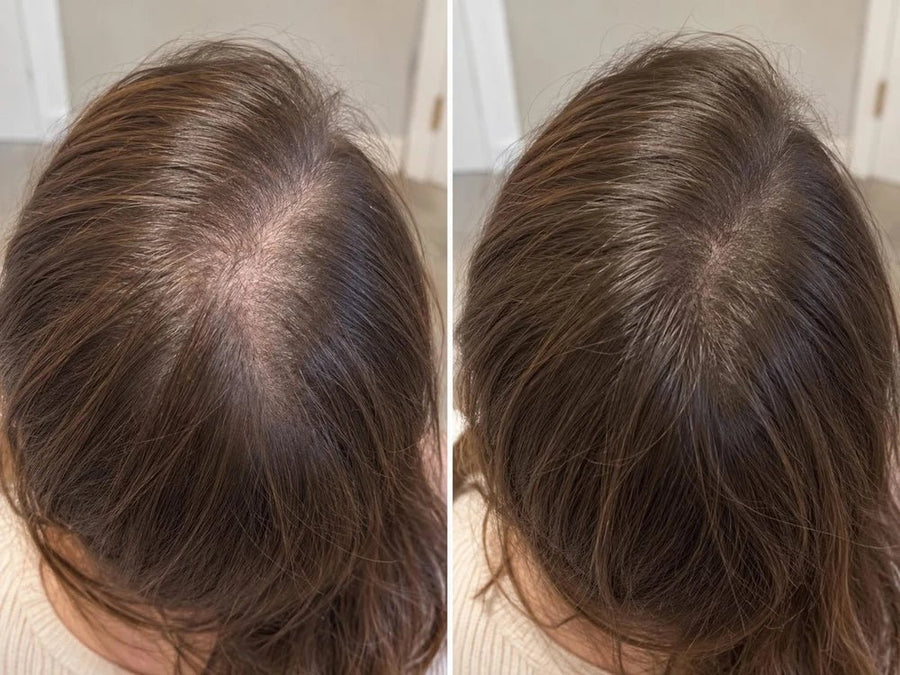 Scalp mai acoperit la creștet